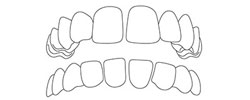 Lücken zwischen den Zähnen · Kieferorthopädie · Zahnregulierung Wien · DDr. Stefan Bollschweiler